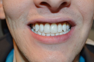 Teeth Whitening Airdrie Hallcraig Dental Care