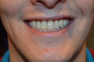 Teeth Whitening Airdrie Hallcraig Dental Care