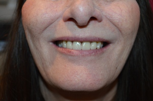 Hallcraig Dental Bridge Work