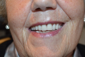 Hallcraig Dental Bridge Work