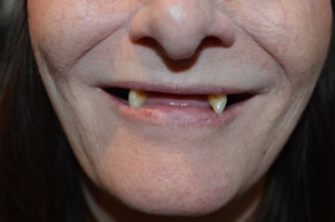 Hallcraig Dental Bridge Work
