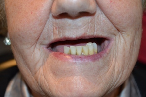 Hallcraig Dental Bridge Work