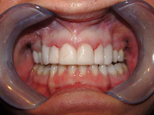 Veneers Airdrie Hallcraig Dental Care