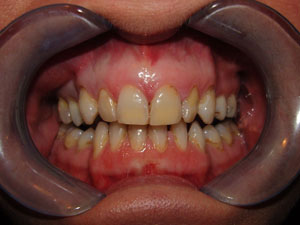 Veneers Airdrie Hallcraig Dental Care