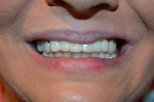 Hallcraig Dental Bridge Work