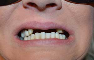 Hallcraig Dental Bridge Work