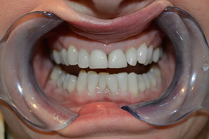 Teeth Whitening Airdrie Hallcraig Dental Care