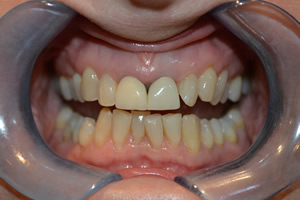 Teeth Whitening Airdrie Hallcraig Dental Care