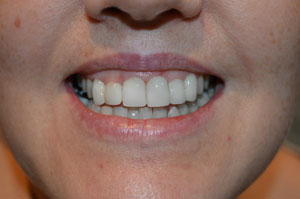 Veneers Airdrie Hallcraig Dental Care