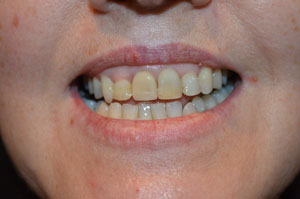Veneers Airdrie Hallcraig Dental Care