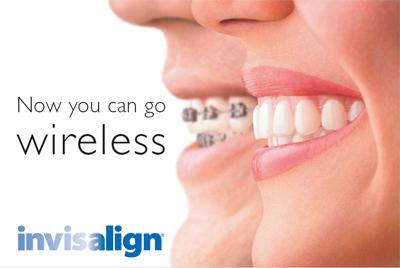 Invisalign